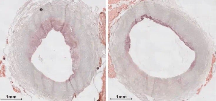 Artère Plaque Nanoparticule